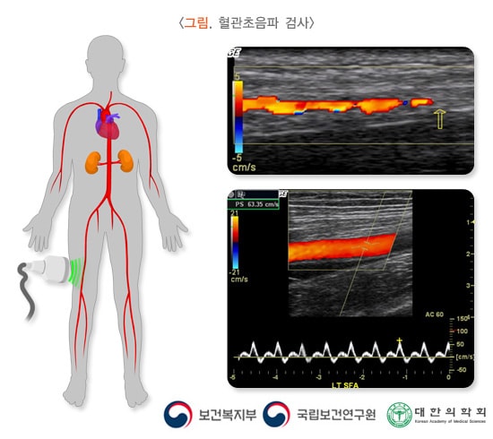 혈관초음파 검사 예시 이미지. 보건복지부, 국립보건연구원, 대한의학회