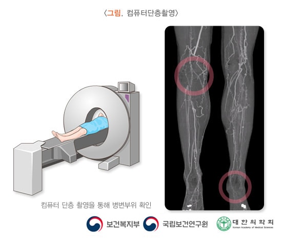 컴퓨터단층촬영 예시 이미지. 컴퓨터 단층 촬영을 통해 병변부위 확인. 보건복지부, 국립보건연구원, 대한의학회