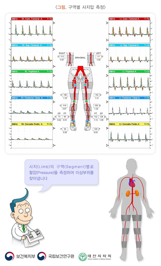 구역별 사지압 측정 예시 이미지. 사지(Limb)의 구역(Segment)별로 혈압(Pressure)을 측정하여 이상부위를 찾아냅니다. 보건복지부, 국립보건연구원, 대한의학회