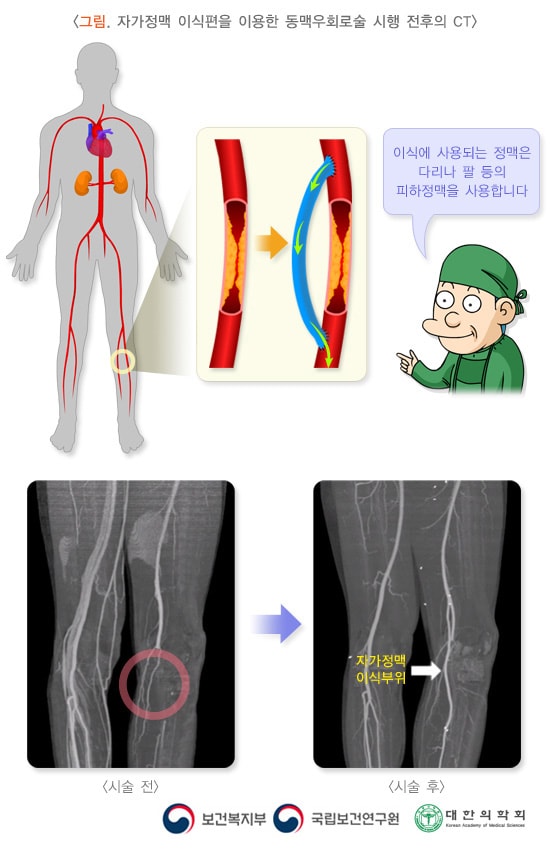 자가정맥이식편을 이용한 동맥우회로술 시행 전후의 CT 비교 이미지. 이식에 사용되는 정맥은 다리나 팔 등의 피하정맥을 사용합니다. 보건복지부, 국립보건연구원, 대한의학회