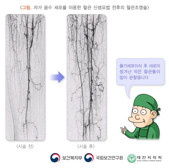 자가 골수 세포를 이용한 혈관 신생요법 전후의 혈관조영술 전후 예시 이미지. 줄기세포이식 후 새로이 생겨난 작은 혈관들이 많이 관찰됩니다. 보건복지부, 국립보건연구원, 대한의학회