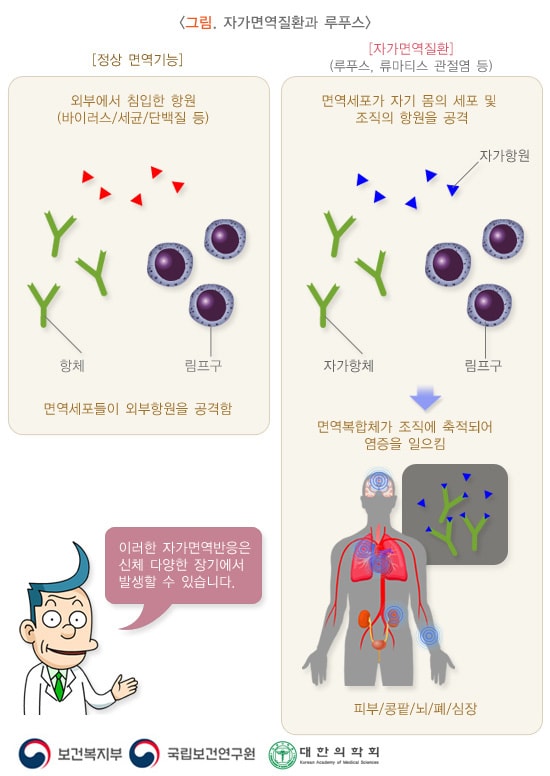 자가면역질환과 루푸스