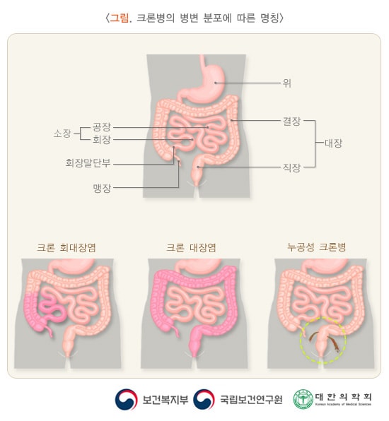 크론병의 병변 분포에 따른 명칭 그림. 크론 회대장염, 크론 대장염, 누공성 크론병. 보건복지부, 국립보건연구원, 대한의학회