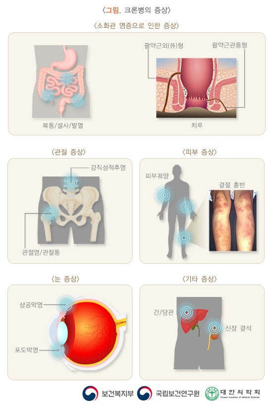 크론병의 증상 그림. 소화관 연증으로 인한 증상: 복통/설사/발열, 치루(괄약근외(外)형, 괄약근관통형). 관절증상: 강직성척추염, 관절염/관절통. 피부 증상: 피부궤양, 결절 홍반. 눈 증상: 상공막염, 포도막염. 기타 증상: 간/담관, 신장 결석. 보건복지부, 국립보건연구원, 대한의학회
