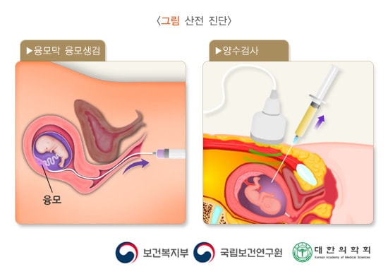 산전 진단
