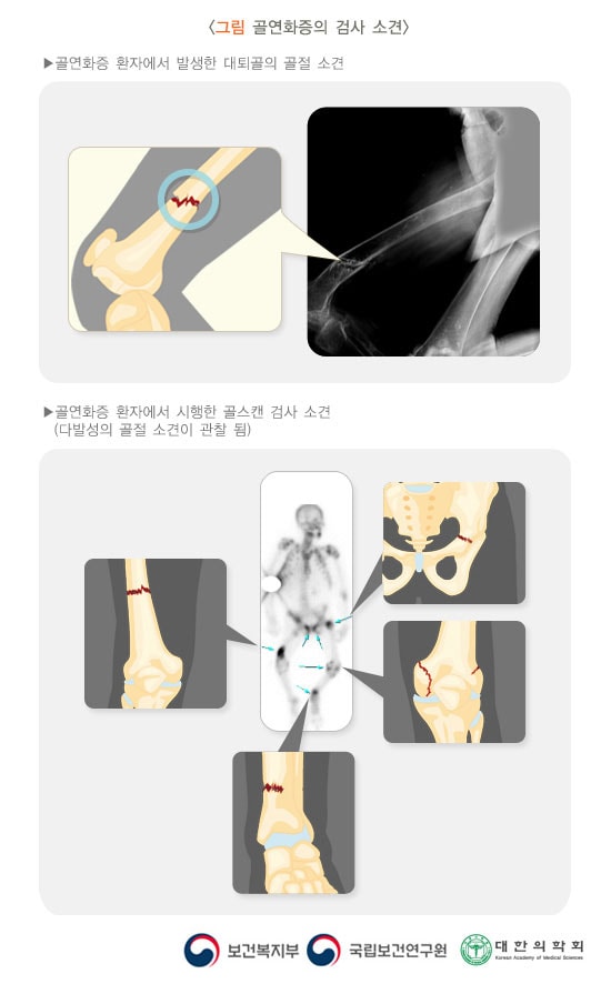 골연화증의 검사 소견