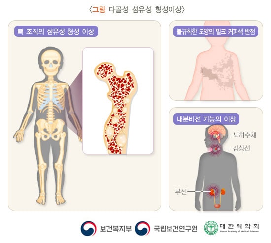 다골성 섬유성 형성이상
