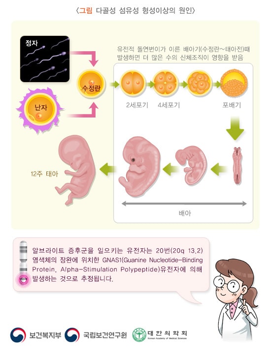 다골성 섬유성 형성이상의 원인