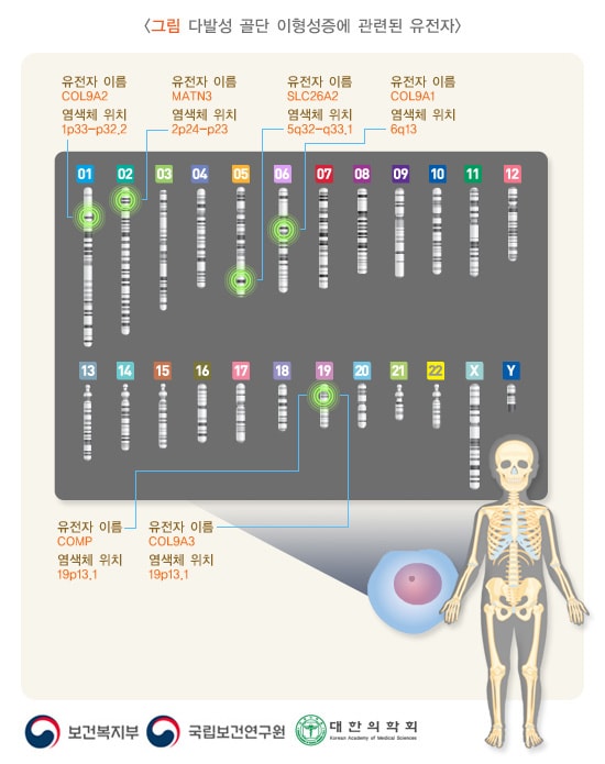 다발성 골단 이형성증에 관련된 유전자: COL9A2(위치:1p33-p32.2), MATN3(위치:2p24-p23), SLC26A2(위치:5q32-q33.1), COL9A1(위치:6q13), COMP(위치:19p13.1), COL9A3(위치:19p13.1)