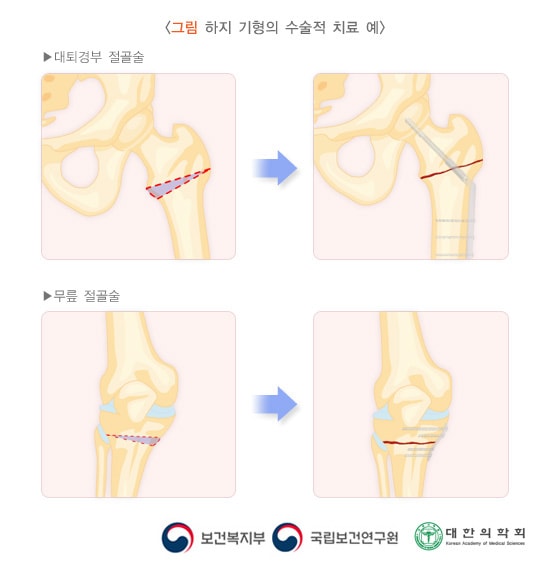 하지 기형의 수술적 치료 예