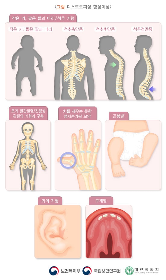 디스트로피성 형성이상