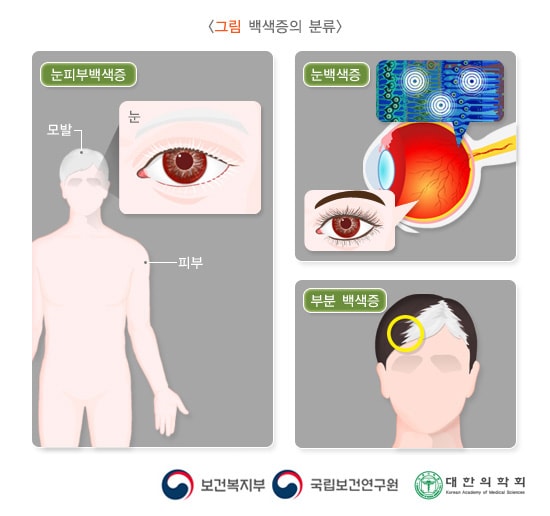 백색증의 분류