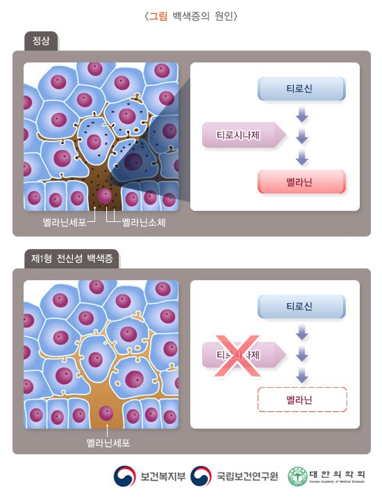 백색증의 원인