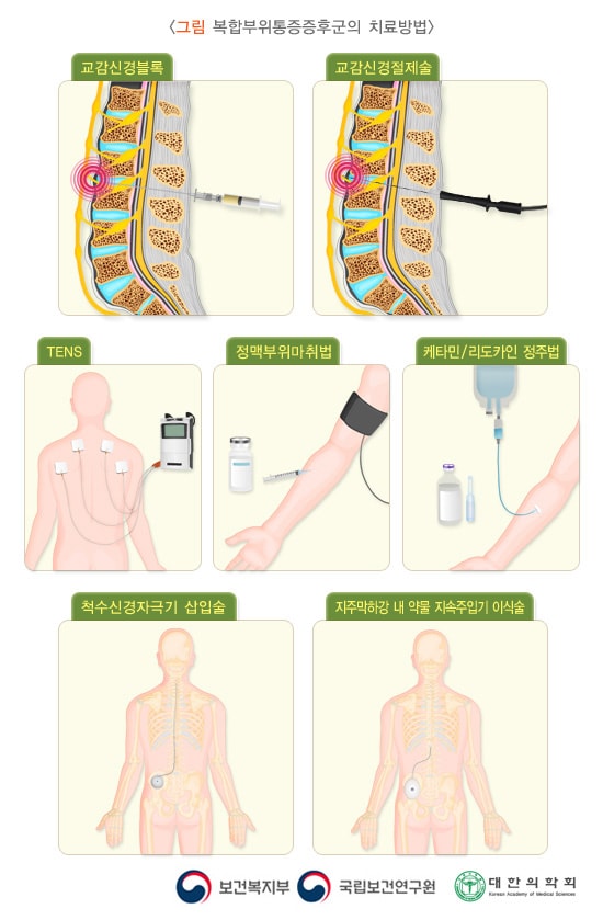 복합부위통증증후군의 치료방법은 교감신경블록, 교감신경절제술, TENS, 정맥부위마취법, 케타민/리도카인 정주법, 척수신경자극기 삽입술, 지주막하강 내 약물 지속주입기 이식술이 있습니다. 보건복지부, 국립보건연구원, 대한의학회.