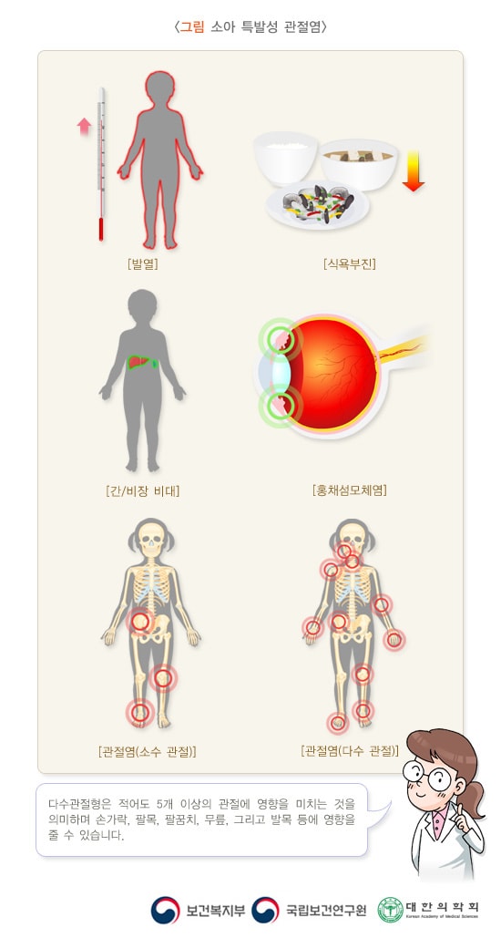 소아 특발성 관절염