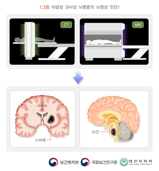 아급성 괴사성 뇌병증의 뇌영상 진단