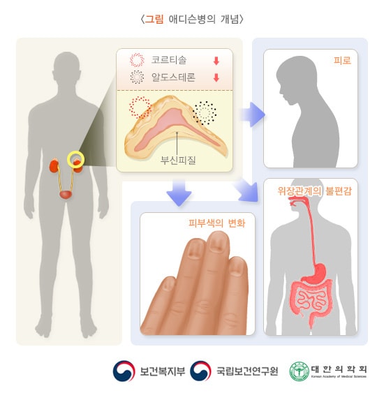 애디슨병의 개념