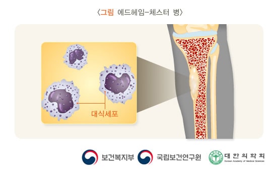 에드하임-체스터 병: 대식세포가 뼈에 침투한 그림