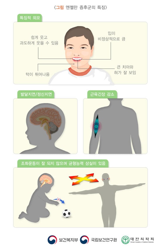 엔젤만 증후군의 특징적 그림: 쉽게 웃고 과도하게 웃을 수 있음, 입이 비정상적으로 큼, 턱이 튀어나옴, 큰 치아와 혀가 잘 보이는 특징적 외모와 발달지연/정신지연과 근육긴장 감소 및 조화운동이 잘 되지 않으며 균형능력 상실이 있음