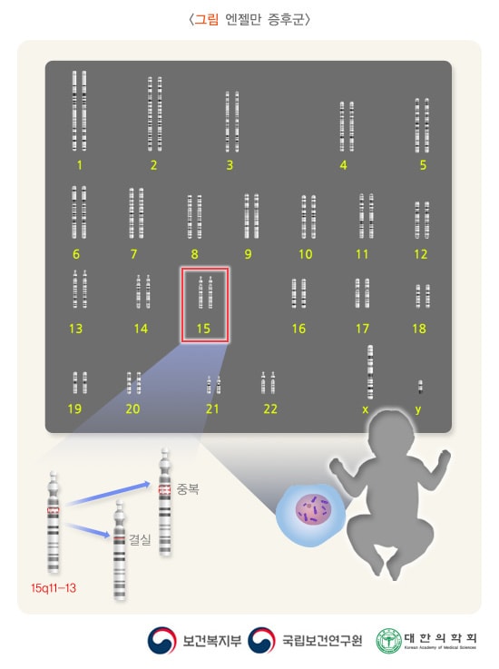 엔젤만 증후군: 15번 염색체의 장완에 위치(15q11-q13)하는 유전자 또는 유전자들의 중복이나 결손으로 일어난다고 생각되어짐