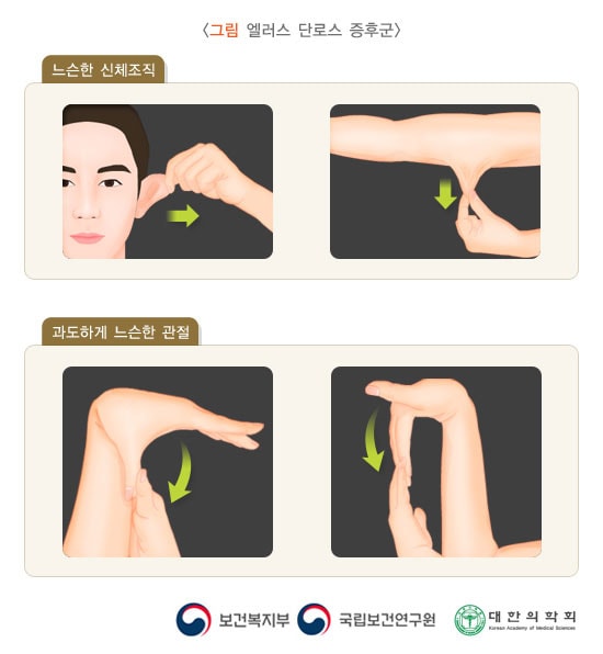 엘러스 단로스증후군
