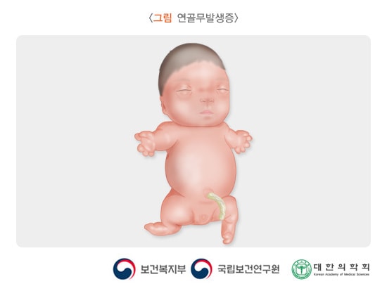 연골무발생증
