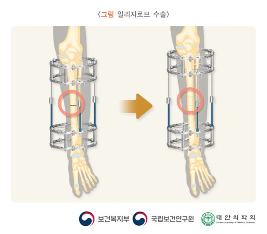 일리자로브 수술