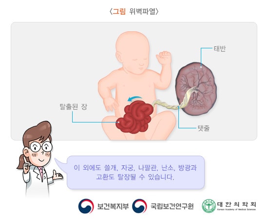 위벽파열