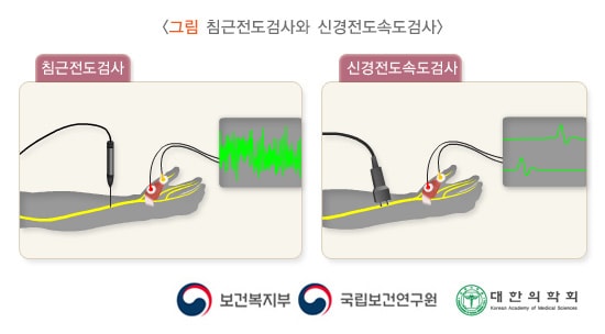 침근전도검사와 신경전도속도검사