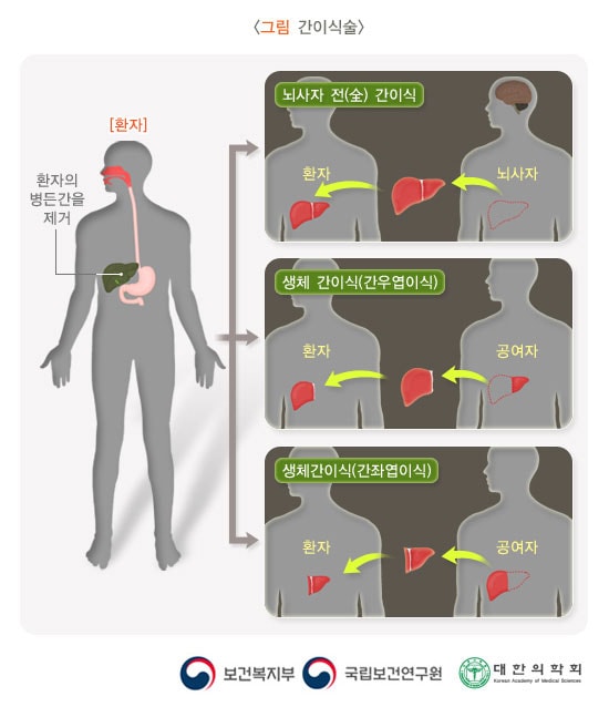 간이식술 그림. 환자의 병든간을 제거 > 뇌사자 전(全) 간이식, 생체 간이식(간우엽이식), 생체 간이식(간좌엽이식) 보건복지부, 국립보건연구원, 대한의학회