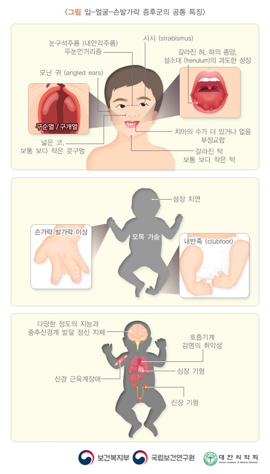 입-얼굴-손발가락 증후군의 공통 특징