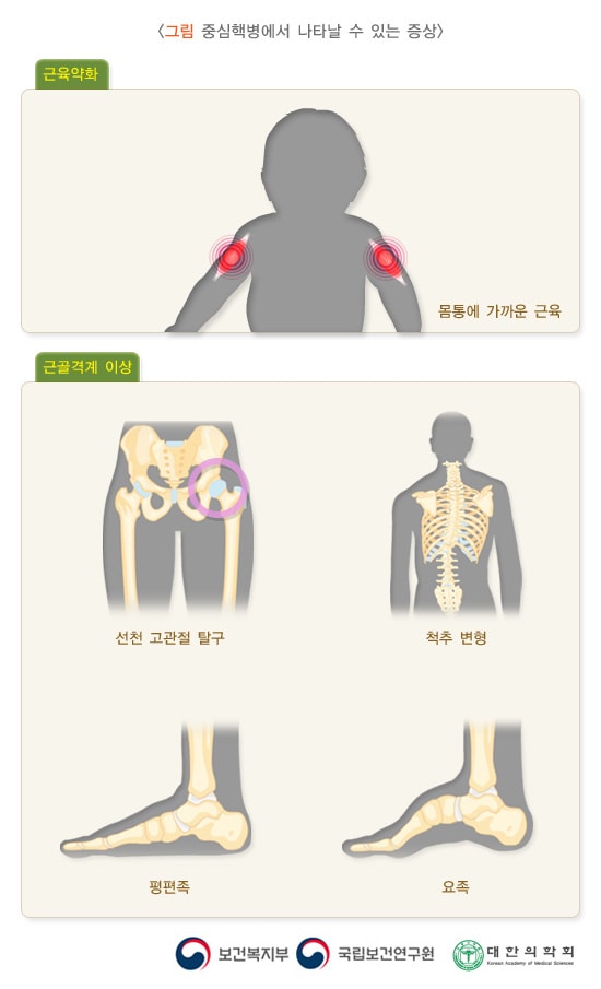 중심핵병에서 나타날 수 있는 증상