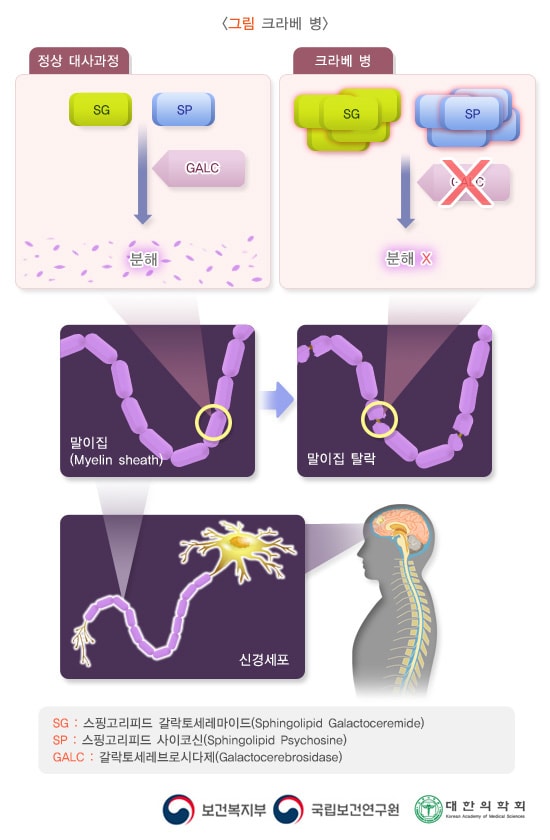 크라베 병