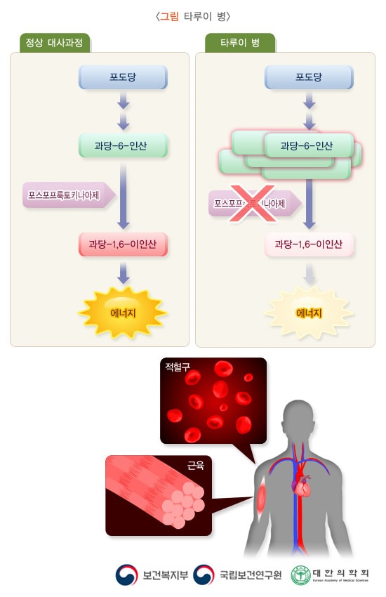 타루이병