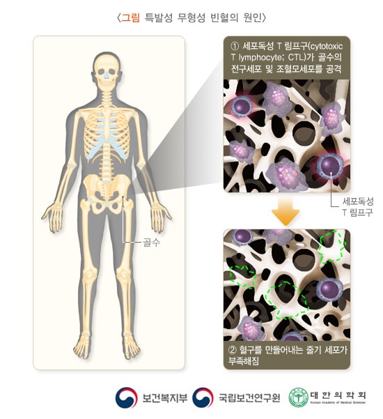 그림 특발성 무형성 빈혈의 원인. 1. 세포독성 T 림프구(cytotoxic T lymphocyte; CTL)가 골수의 전구세포 및 조혈모세포를 공격. 세포독성 T 림프구로 인해 2. 혈구를 만들어내는 줄기 세포가 부족해짐. 보건복지부, 국립보건연구원, 대한의학회