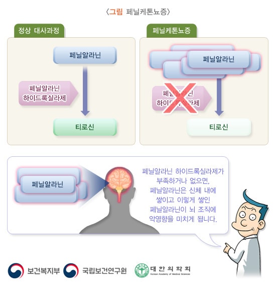 페닐케톤뇨증