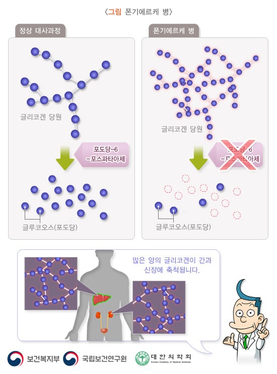 폰기에르케 병