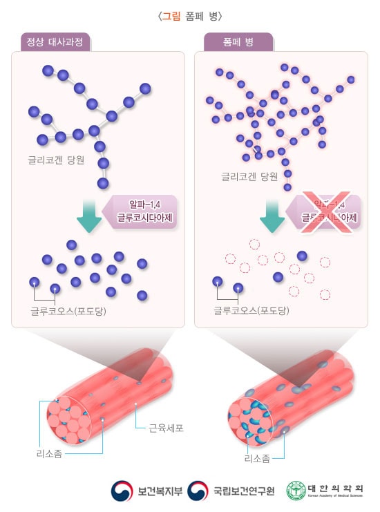 폼페 병