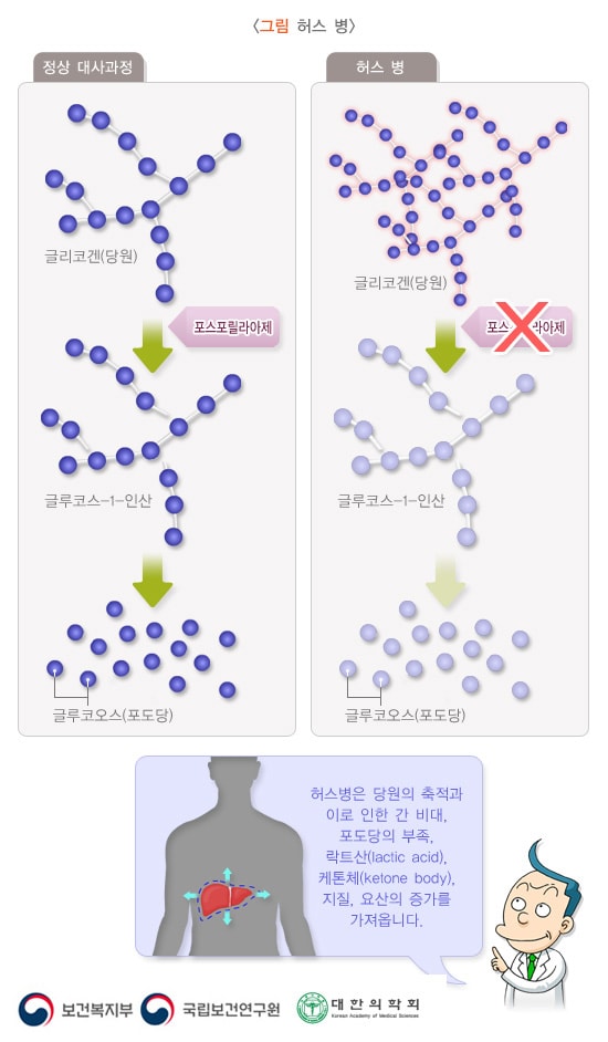 허스 병
