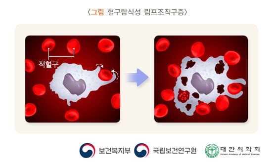 혈구탐식성 림프조직구증후군