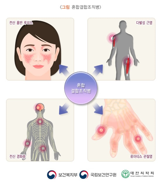 혼합결합조직병