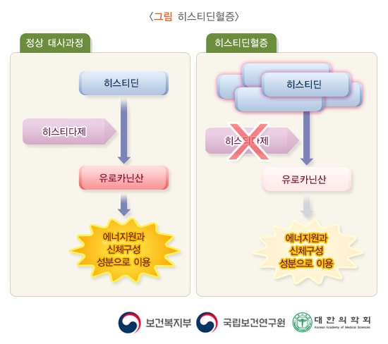 히스티딘 혈증