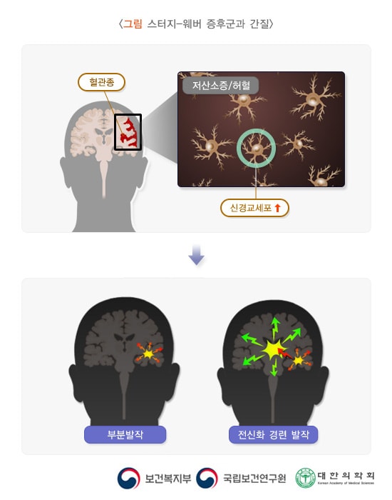 스터지-웨버 증후군과 간질