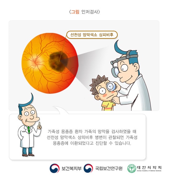 그림 안저검사. 선천성 망막색소 상피비후. 가족성 용종증 환자 가족의 망막을 검사하였을 때 선천성 망막색소 상피비후 병젼이 관찰되면 가족성 용종증에 이환되었다고 진단할 수 있습니다. 보건복지부, 국립보건연구원, 대한의학회