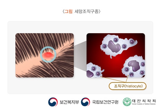 세망조직구종