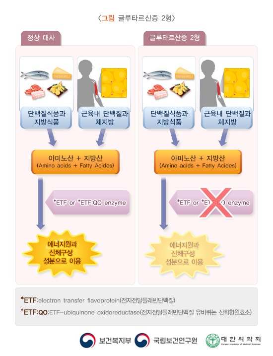 글루타르산증 2형