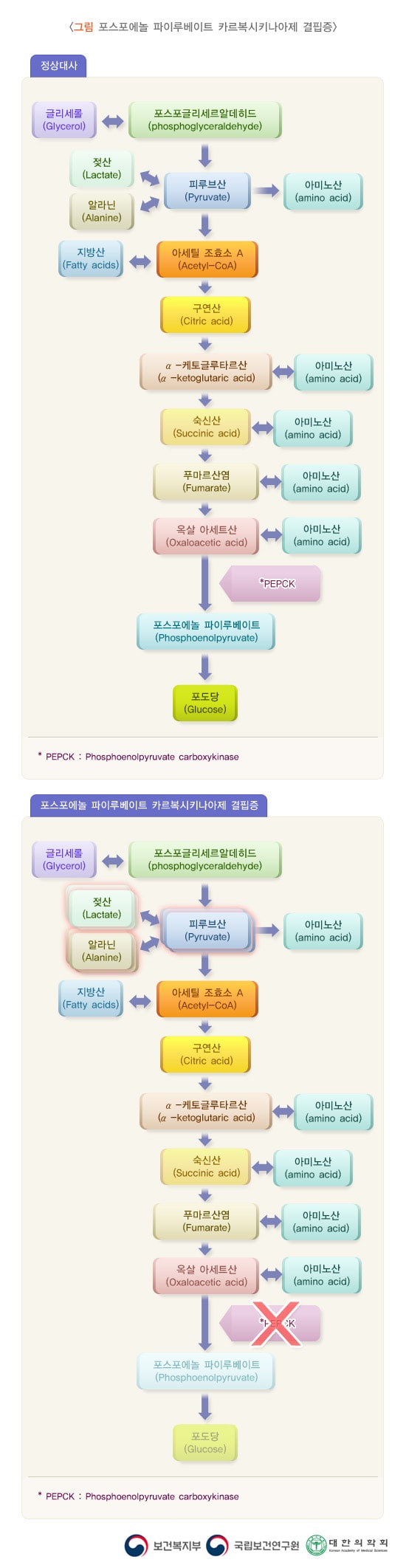 포스포에놀 파이루베이트 카르복시키나아제 결핍증