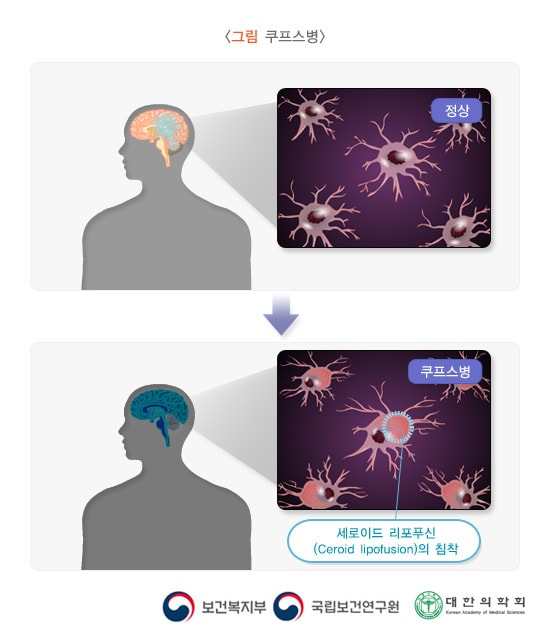 쿠프스병