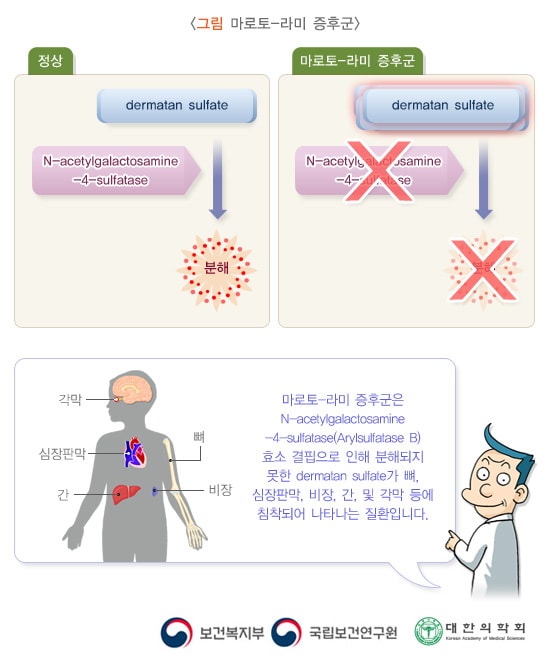 마로토-라미 증후군