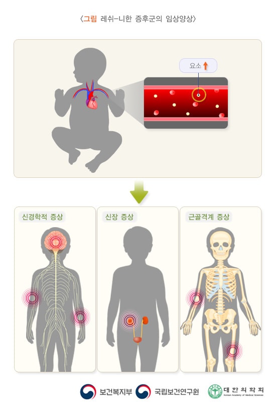 레쉬-니한증후군의 임상양상